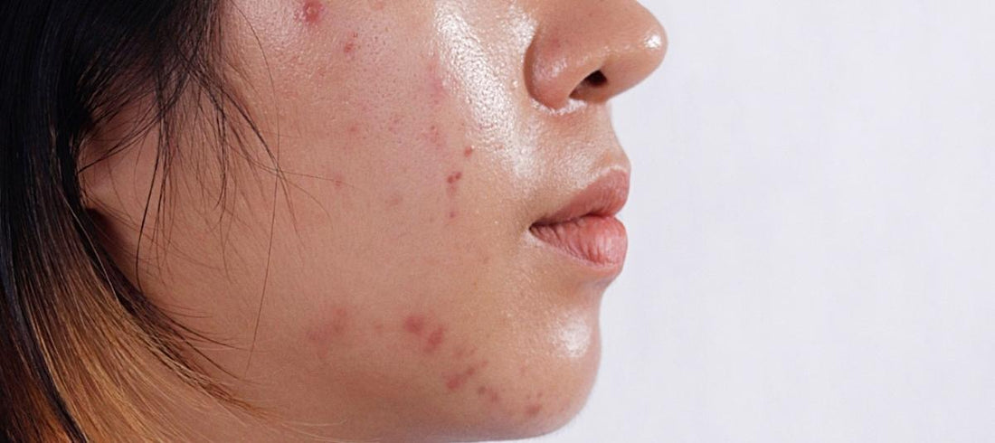 6 Best  Oily Skin Care Hacks For Monsoon Season