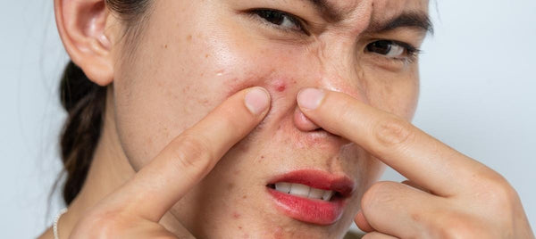 8 Effective Tips To Control Monsoon Acne