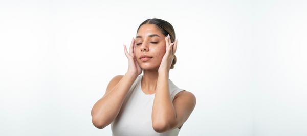 Is Vitamin C good for sensitive, acne-prone skin?