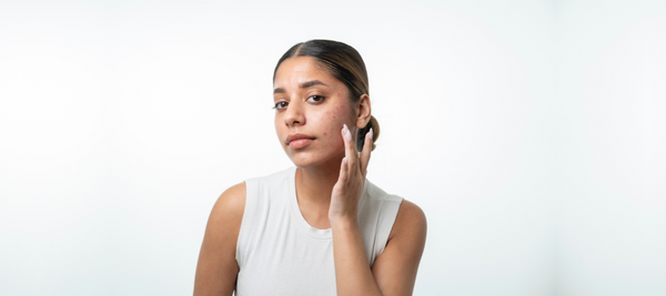 Best skincare ingredients to get rid of acne scars