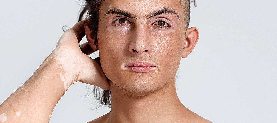 What Causes White Patches On Face?