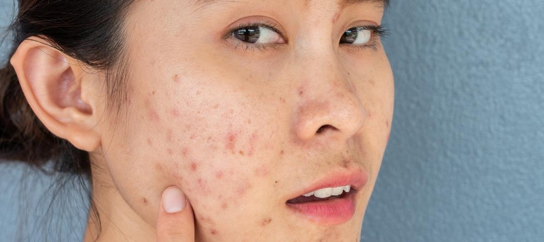 What Is Post-Inflammatory Erythema (PIE) And How Is It Treated?