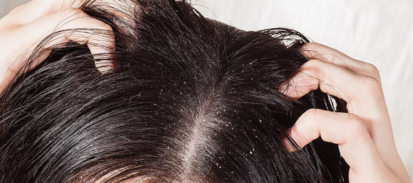 What Is The Best Thing For Dandruff? Know here