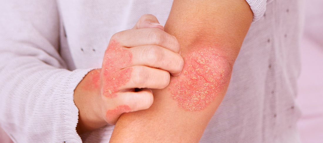 What Are the Best and Worst Ingredients For Atopic Dermatitis?