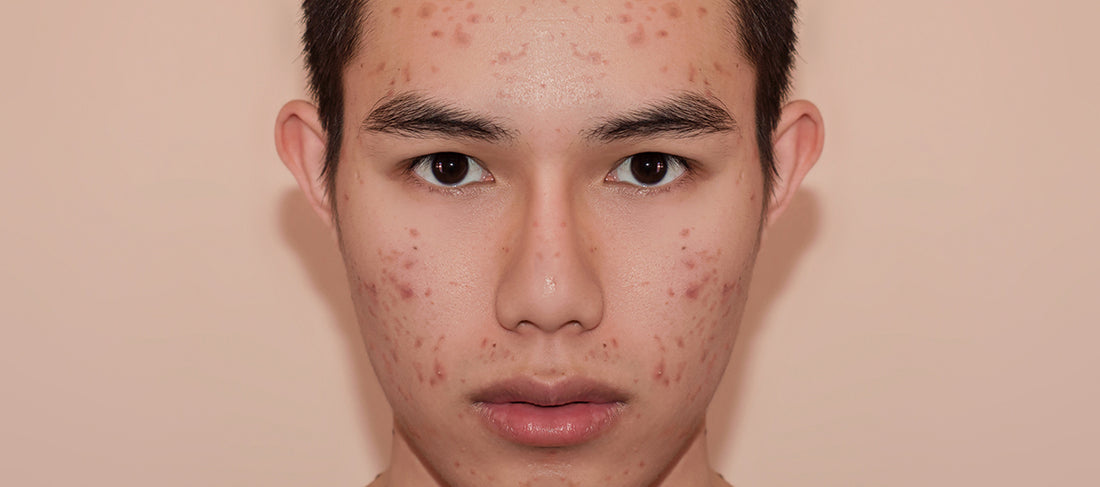 4 Powerful Ingredients To Clear dark spots left by Acne