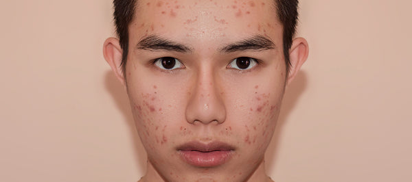 4 Powerful Ingredients To Clear Dark Spots Caused By Acne