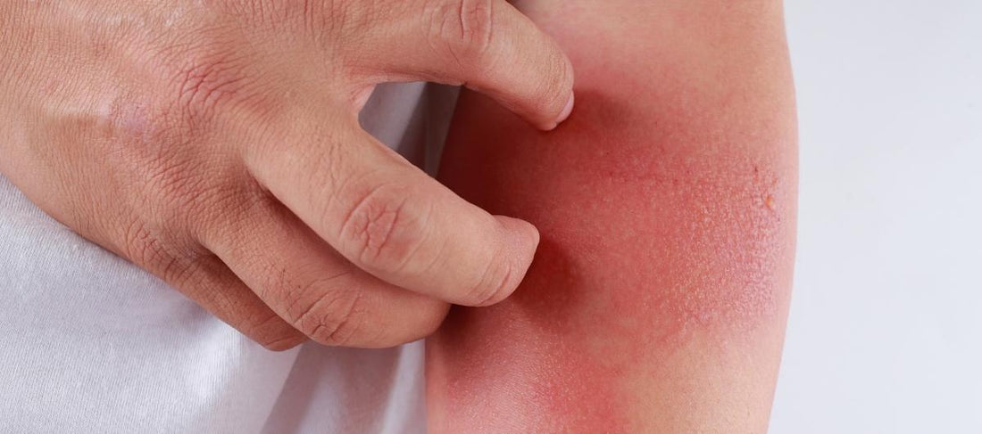 6 Ways to Avoid Eczema Flare-Ups in Monsoon