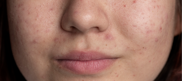 6 Ways to Smooth Uneven Skin Texture on Face