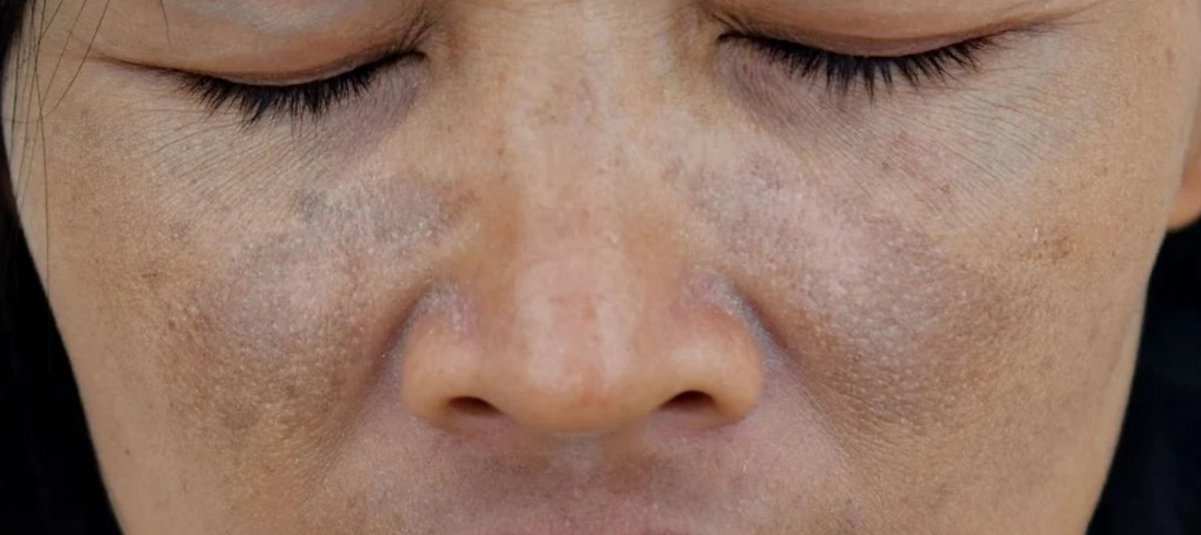Easy 5 step skin care routine for hyperpigmentation and dark spots