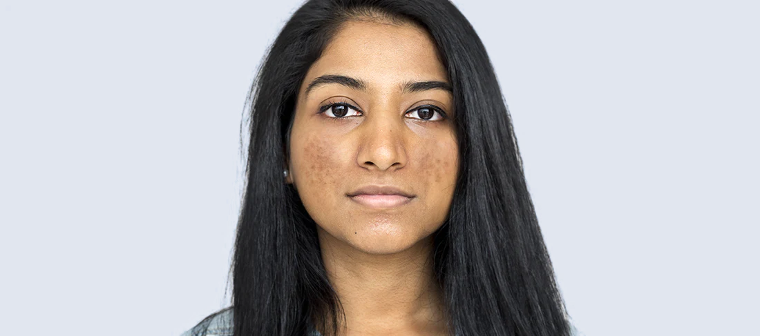 5 Daily Habits to Quit When You Have Hyperpigmentation/Dark Spots