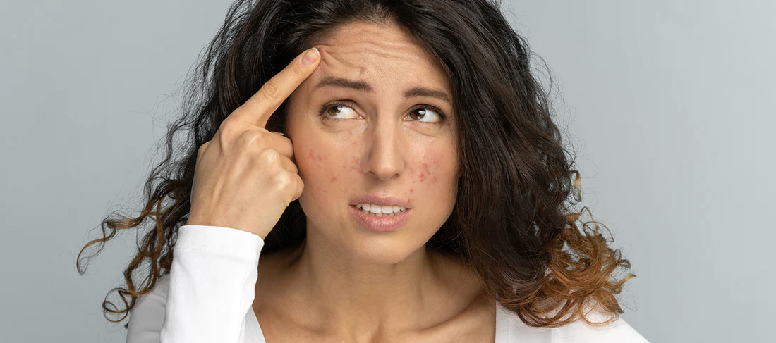 Know Your Acne Type, Causes, Treatments. These Pictures Will Tell You.  (Expert Video Inside)