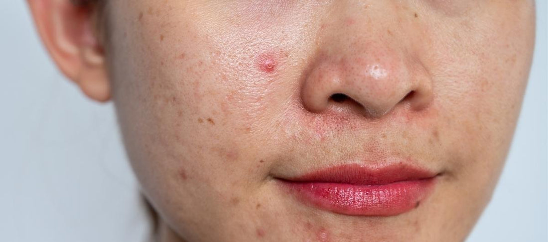 4 Easy and effective remedies for oily and acne-prone skin 