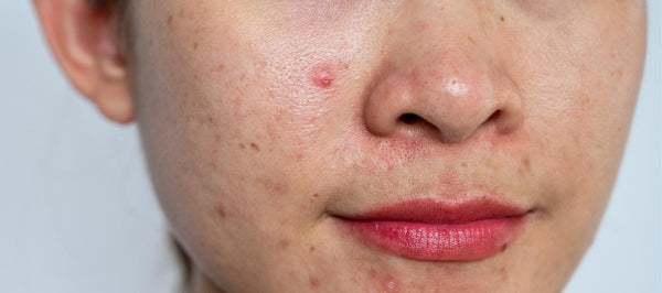 4 Easy and effective remedies for oily and acne-prone skin