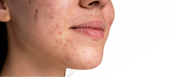 The Internet Says Cold Showers Reduce Acne—Is It True?