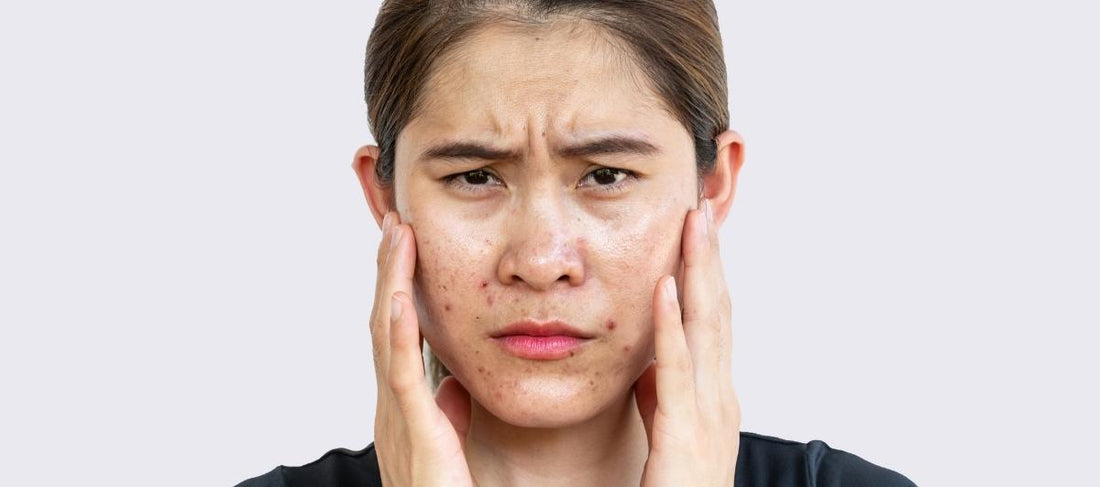 Need Sunscreen For Oily/Acne Prone Skin? Here’s The Right One