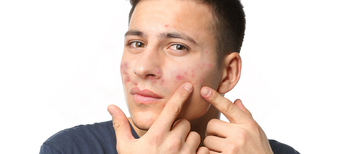 Why Is My Face Breaking Out All Of A Sudden? Re'equil