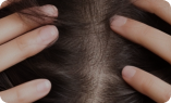 Hair Fall