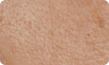 Enlarged pores