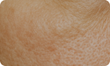Uneven skin texture