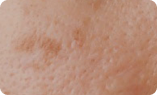 Prevent sun damage