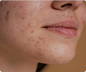 Prevents acne