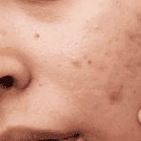 Acne & Acne Scars