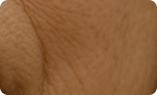Fine lines and wrinkles