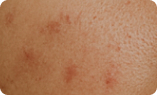 Acne scars