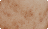Dark Spots & Pigmentation