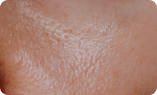 Excess Oil / Shine on face